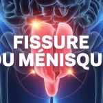 schéma genou fissure du ménisque